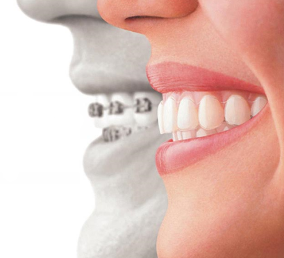 Clear Orthodontic Aligners
