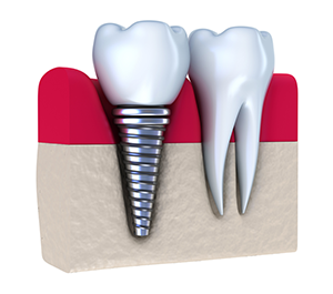 dental implant restorations Evans & Augusta, GA